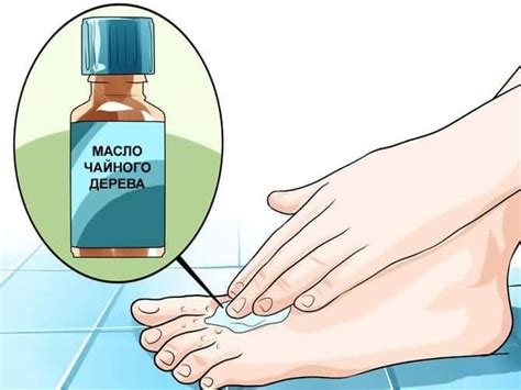 Масло чайного дерева от грибка ногтей на руках и ногах