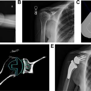 A Preoperative Axillary Radiograph B Preoperative AP Radiograph