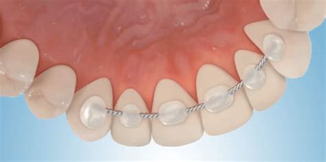 Invisalign Dr Fr D Rique Michel