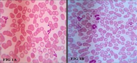 A And B Peripheral Smear Showing Platelet Clumps Leishman S Stain