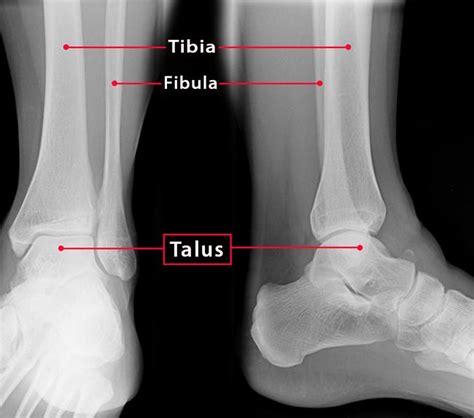 Talus Bone — Definition, Location, Anatomy, Diagrams