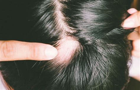 Alopecia Causes Symptoms And Treatments