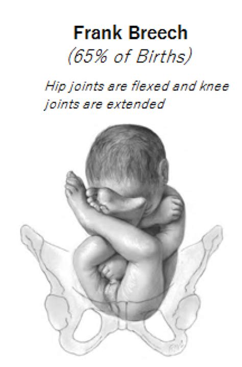 英汉-汉英词典 Breech birth是什么意思_