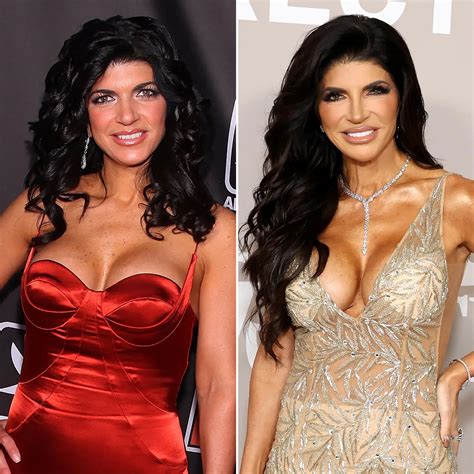 Teresa Giudice and the Buzz Around Her Plastic Surgery Journey | Bizrahmed