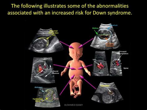 1 Fetal Genetic Ultrasound Dr Ahmed Esawy