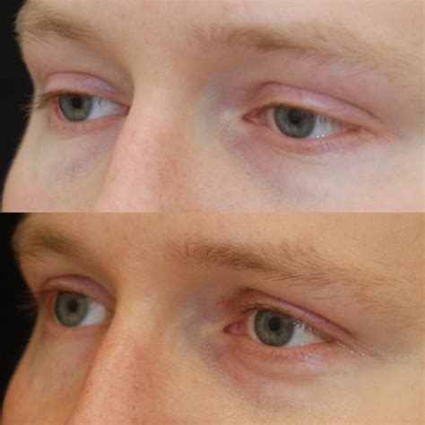 What Do Scars After Eyelift Blepharoplasty Look Like — Lara Devgan Md Mph Facs