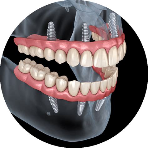 All On 4 Full Mouth Dental Implants Florence Louisville KY