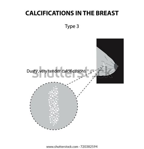 Calcifications Breast Mammography Mammary Gland Infographics Stock Vector Royalty Free