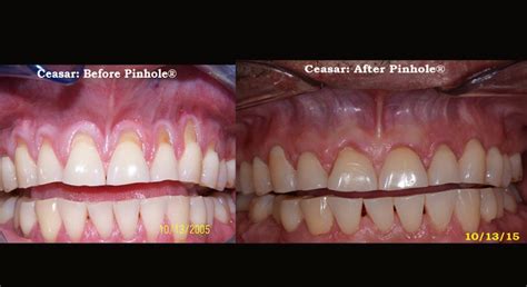 Pinhole Gum Rejuvenation™ La Jolla Ca La Jolla Dental Implants And