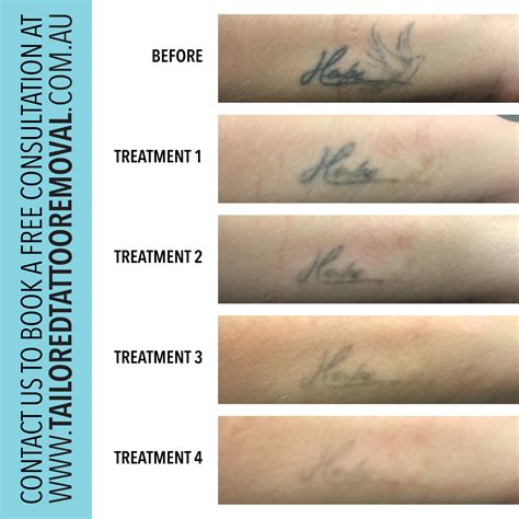 Treatment Progress Tailored Tattoo Removal Melbourne