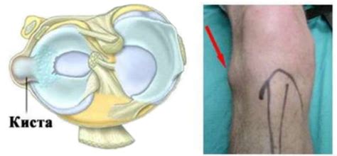 Травмы и заболевания коленного сустава Артроскопическая менискэктомия ...