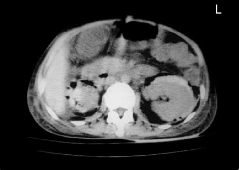 Figure 1 From Bilateral Emphysematous Pyelonephritis Combined With Subcapsular Hematoma And