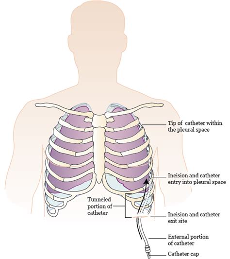 Infected Pleurx Catheter