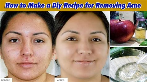 How To Make A Diy Recipe For Removing Acne Remove Acne Permanently Get Rid From Acne Youtube