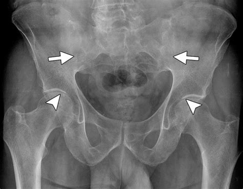 Sacroiliitis Associated With Axial Spondyloarthropathy New Concepts