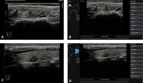 Thyroid Nodules S Detect Technique In The Samsung Rs80a Ultrasound