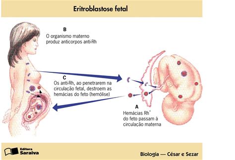 O Que É Eritroblastose Fetal - Portal del Profesor - O que é Eritroblastose Fetal? - UCA