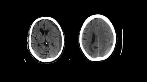 Imaging In Head Trauma Youtube