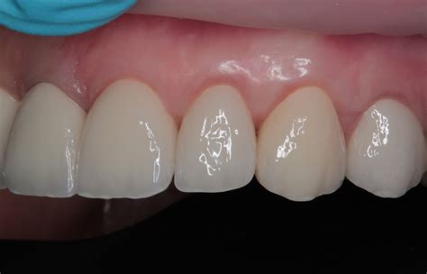 Zirconium Crowns Aupark Dental Office