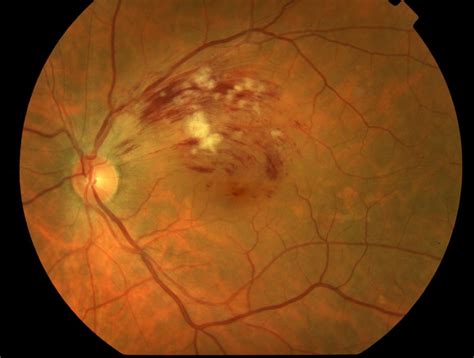 Retinal Vein Occlusions Infinitieye