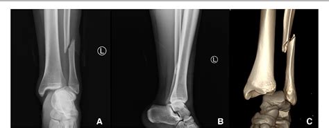 Figure 3 From Posttraumatic Checkrein Deformity Following Isolated