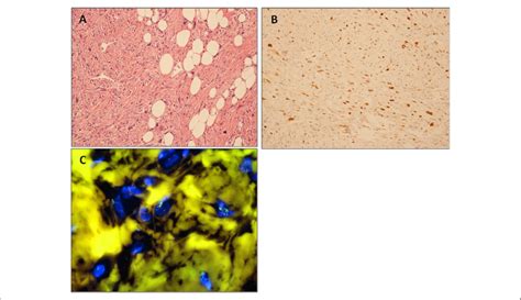 A Hematoxylin And Eosin High Grade Dedifferentiated Liposarcoma