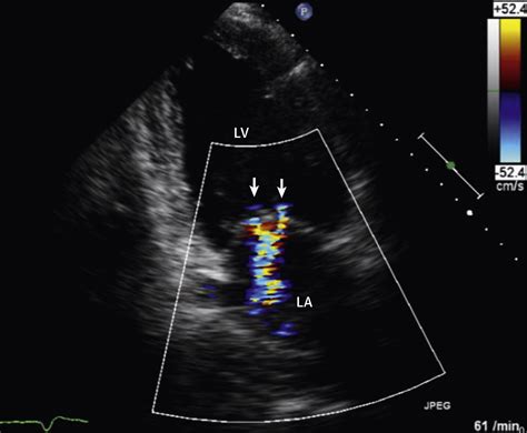 Basic Principles Of The Echocardiographic Evaluation Of Mitral