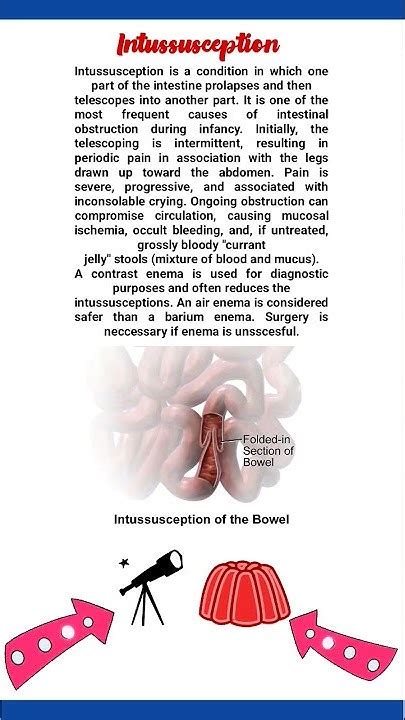 Nclex Review Intussusception Youtube