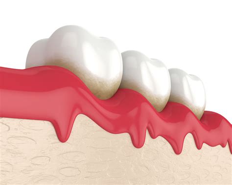 Home Remedies To Fight Gum Disease Onatsky Dental Clinic