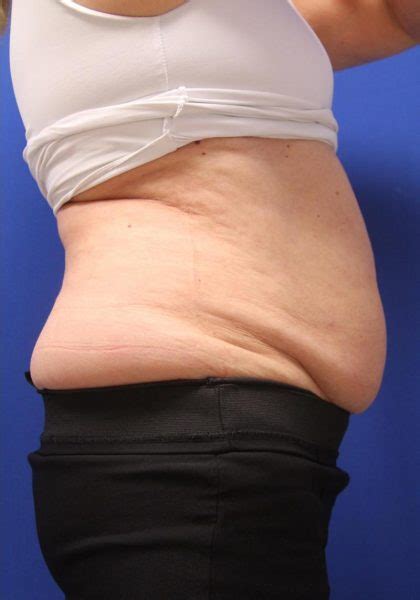 Patient Coolsculpting Elite Before And After Photos New York Ny