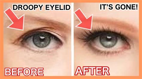 Get Rid Of Droopy Eyelid Eye Wrinkles Naturally Make Your Eyes