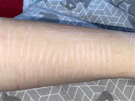 When scars are white, is that how they’ll be forever? These are about a