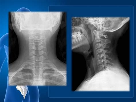 Anatomia Columna Cervical PPT