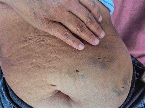 Mulher relata violência extrema após ter vagina cortada pelo ex companheiro