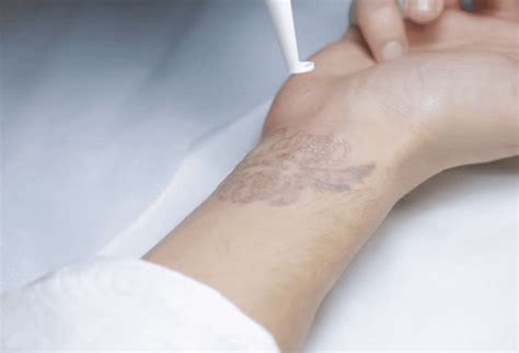 Is Your Unwanted Tattoo Making You Feel Uncomfortable In Your Bikini