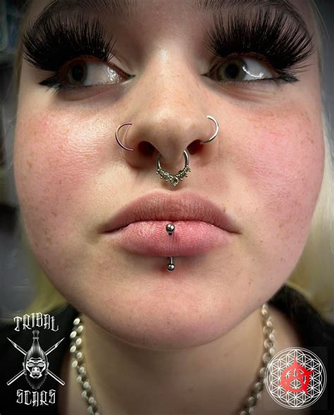 Vertical Labret Piercing Scar