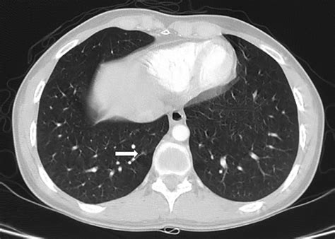 year  woman  hydatidiform mole metastasizing   lung
