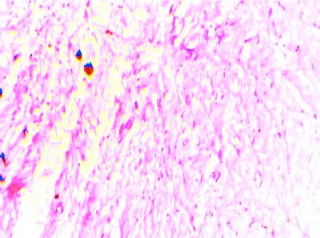 Photomicrograph Of Tissue From The Excised Mass Showing The