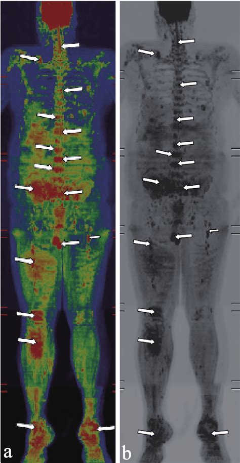 A Magnetic Resonance Imaging Whole Body Diffusionweighted Image