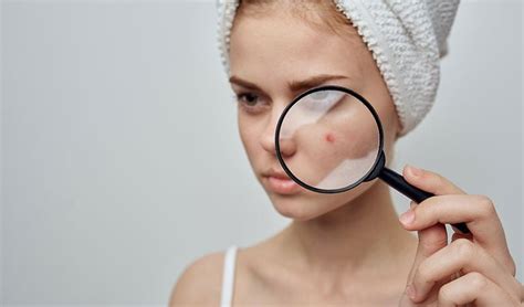 3 Ways To Conceal Red Spots On Your Face - Skincare Tips