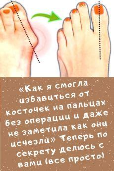 «Как я смогла избавиться от косточек на пальцах без операции и даже не ...