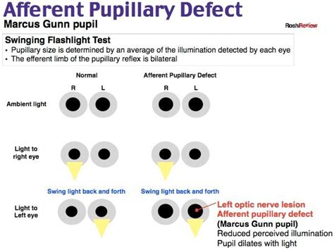 Afferent Pupillary Defect | Internal medicine, Medicine, Emergency medicine