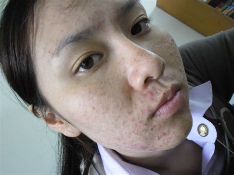 Dùng kem trộn không rõ nguồn gốc hot girl Thái Lan mọc mụn chi chít