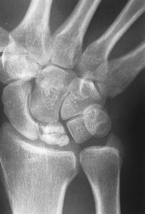 Lunate Dislocation, Emergency Medicine | Diseases & Conditions ...