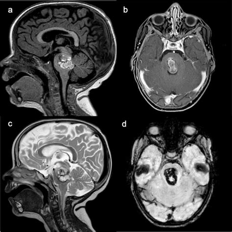 Post Operative Axial Contrast Enhanced T1 Weighted A And Sagittal