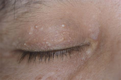 Lumps And Bumps On Eyelid Olelo