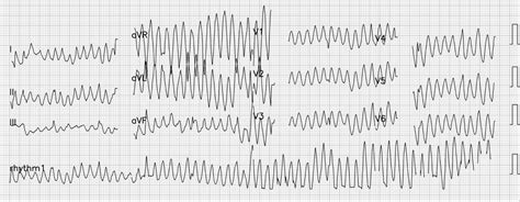 Ritu Thamman Md On Twitter Rt Ecgoxford What A Rhythm To Start The