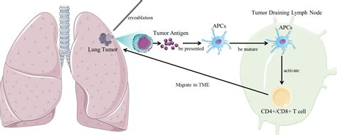 Frontiers | Cryoablation and immune synergistic effect for lung cancer ...