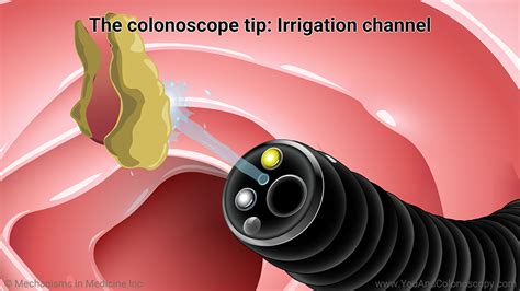 Slide Show What Happens During And After A Colonoscopy