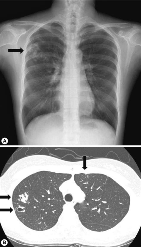 Follow Up Chest X Ray And Ct A Interval Decreases In The Size Of